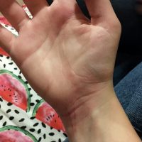 Bruised hand caused by a tic attack, tourette's syndrome